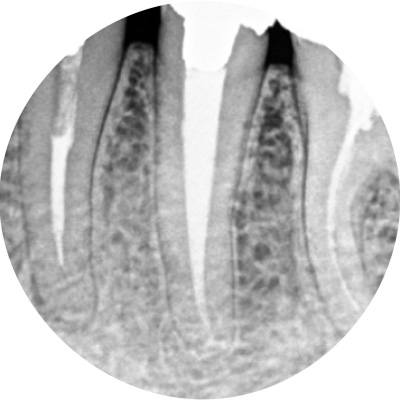 歯内療法の画像